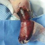 خطأ طبي يفقد قدم “الطفل خالد الشمري” بسببه في مستشفى لطب وجراحة القلب بالدمام